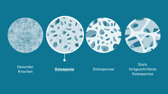 Osteopenie und Osteoporose Stufen im Knochen | © BIOGENA