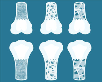 Stufen: Normaler Knochen, Osteopenie, Osteoporose