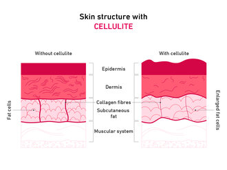 Graphic explaining the connection between collagen and cellulite