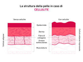Grafico che spiega la relazione tra collagene e cellulite