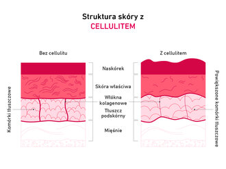 Grafika wyjaśniająca związek między kolagenem a cellulitem